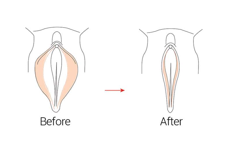 Vaginoplastia